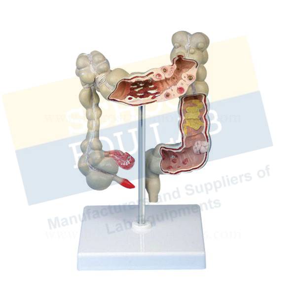 Colon Model With Pathologies