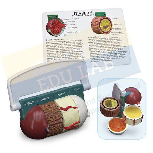 Diabetes Model Set of 4 Piece