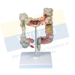 Colon Model With Pathologies
